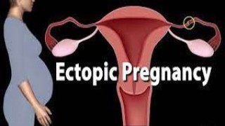 Transvaginal Ovary Extraction via Laparoscopic Salpingo-Oophorectomy
