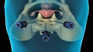 Total Laparoscopic Hysterectomy: Integrating ICG & U-Kit and Safe Contained Morcellation