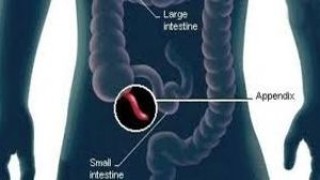 Laparoscopic Repair of Small Umbilical Hernia without Mesh
