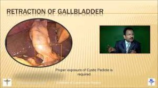 Laparoscopic TAPP Hernia Repair
