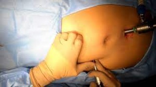 Major Vessel Bleeding and the Risk of Air Embolism