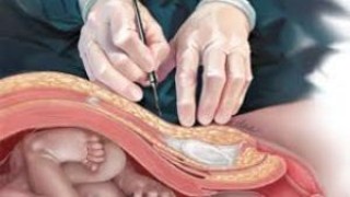 Minimally Invasive Marvel: Laparoscopic Surgery for Ovarian Dermoid Cyst