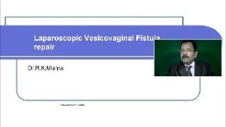 Laparoscopic Removal of Posterior Cervical Fibroid