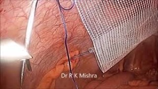 Laparoscopic TAPP Hernia Repair