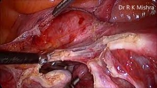 Robotic Reversal of Tubal Sterilization