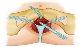 Robotic Hernia Surgery by Dr. R.K. Mishra - External View
