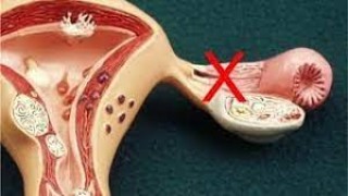 गर्भाशय की रसौली: बच्चेदानी में गांठ होने के लक्षण, कारण, इलाज व बचाव के बारे में जानें