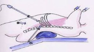 Dr. Mishra's Lecture on Axilloscopy at CAMLS, Florida, USA