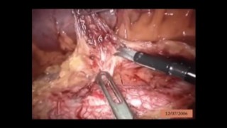 Enhancing Hernia Care: Minimally Invasive Transabdominal Preperitoneal Repair