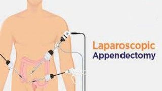 Revolutionizing Hernia Surgery: How Robotics is Enhancing Inguinal Hernia Repair for Patients
