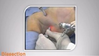Laparoscopic Fundoplication