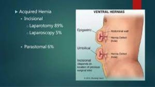 Choledocoscopy at World Laparoscopy Hospital
