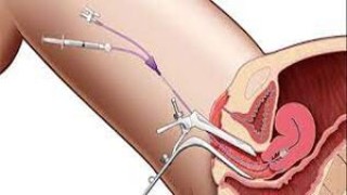 Mastering Complexity: Conquering Difficult Total Laparoscopic Hysterectomy with Precision and Skill