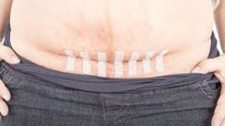 Revolutionizing Hernia Surgery: How Robotics is Enhancing Inguinal Hernia Repair for Patients