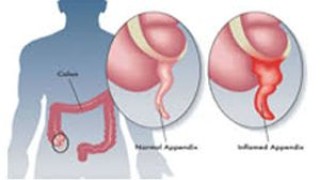 Laparoscopic Hysterectomy