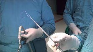 Laparoscopic Management of Posterior Intramural Fibroid