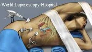 Dr R K Mishra demonstrating Laparoscopic Sterilization with Harminic Scalpel