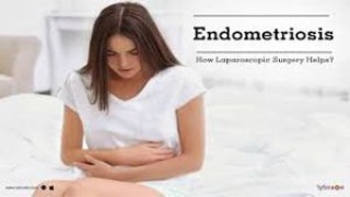 Laparoscopic Surgery for Endometriosis
