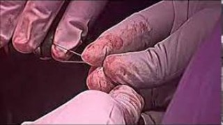 Laparoscopic Tayside Knot demonstration by Dr R K Mishra
