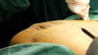 Total Laparoscopic Hysterectomy by Three 5 mm Ports