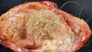 Laparoscopic Disposable Trocars