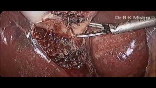 da Vinci Robotic Inguinal Hernia Surgery by Dr. R.K. Mishra