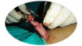 Laparoscopic Cholecystectomy with ligation of cystic duct by Dr R K Mishra