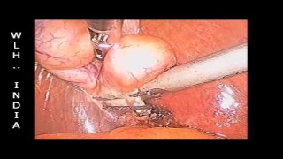 Ipom Inguinal Hernia Surgery by Suturing - Personnel Technique Dr R K Mishra