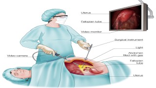 Live Surgery Demonstration of Laparoscopic Mishra's Knot