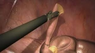 How to Use Hysteroscopy Instruments?