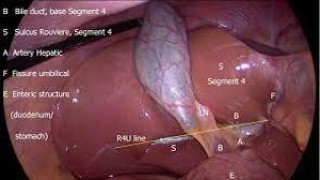 Laparoscopic Repair of Huge Incisional Hernia by Dr. R.K. Mishra