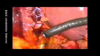 Full Length Lap Chole Video in HD