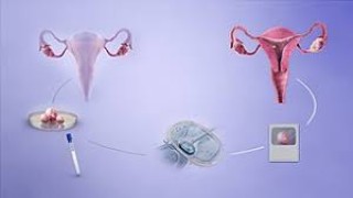 Unedited Full Length Laparoscopic Cholecystectomy HD Video - Dr R K Mishra