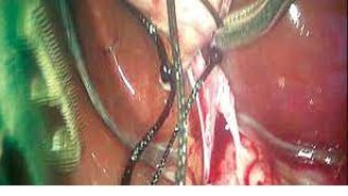 What is Ovarian Cyst and how can it be treated?