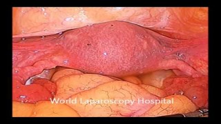 Exploring Laparoscopic Surgery: A Captivating Demonstration of the Essential Laparoscope Telescope