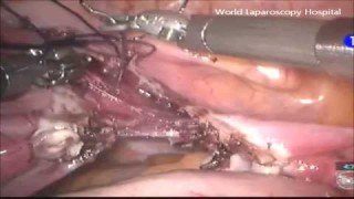 Total Robotic Hysterectomy with suturing of uterine artery