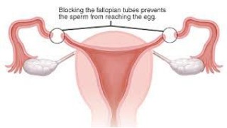 Laparoscopic Radical Hysterectomy