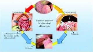 Robotic Surgery at World Laparoscopy Hospital