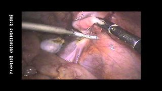SILS - Single Incision Laparoscopic Surgery