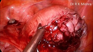 Laparoscopic Cholecystectomy with Meltzer Knot in mass ligation HD