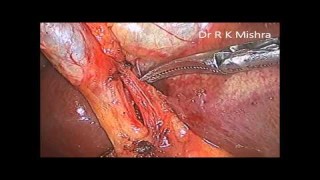 Laparoscopic Nephrectomy