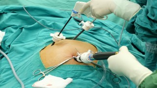Laparoscopic Hernia Repair Large Sac TAPP Repair