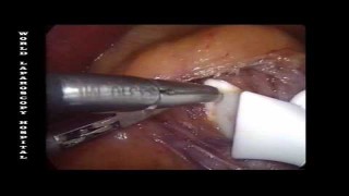 Laparoscopic Salpingo-oophorectomy by Dr R.K. Mishra