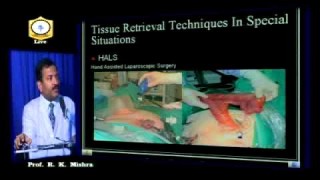 Supracervical Hysterectomy in a Patient with severe adhesion