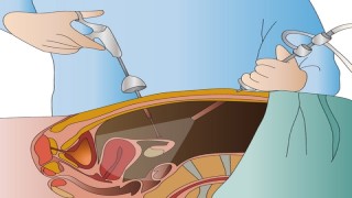 Laparoscopic Trans Abdominal Pre-Peritoneal Repair of Left Direct Inguinal Hernia