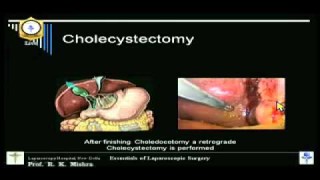 Fixation of T Tube