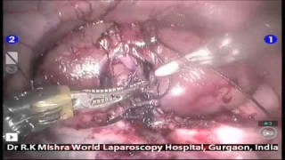 Webinar on Tips and Tricks of Total Laparoscopic Hysterectomy