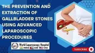 High Definition Video of Lap Chole with Extracorporeal Knot to Cystic Duct