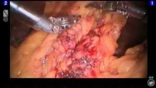 Laparoscopic Hysterectomy And Appendectomy Using Illuminated Ureteral Stent Step Step Demonstration