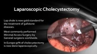 Suprapubic Incisional Hernia Repair